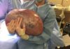 50-pound ovarian cyst removed from woman