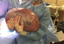 50-pound ovarian cyst removed from woman