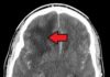 Scientists find chemical to kill brain tumour cells