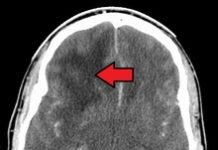 Scientists find chemical to kill brain tumour cells