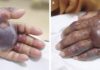 Man’s arm amputated after eating sushi Flesh eating disease from raw seafood